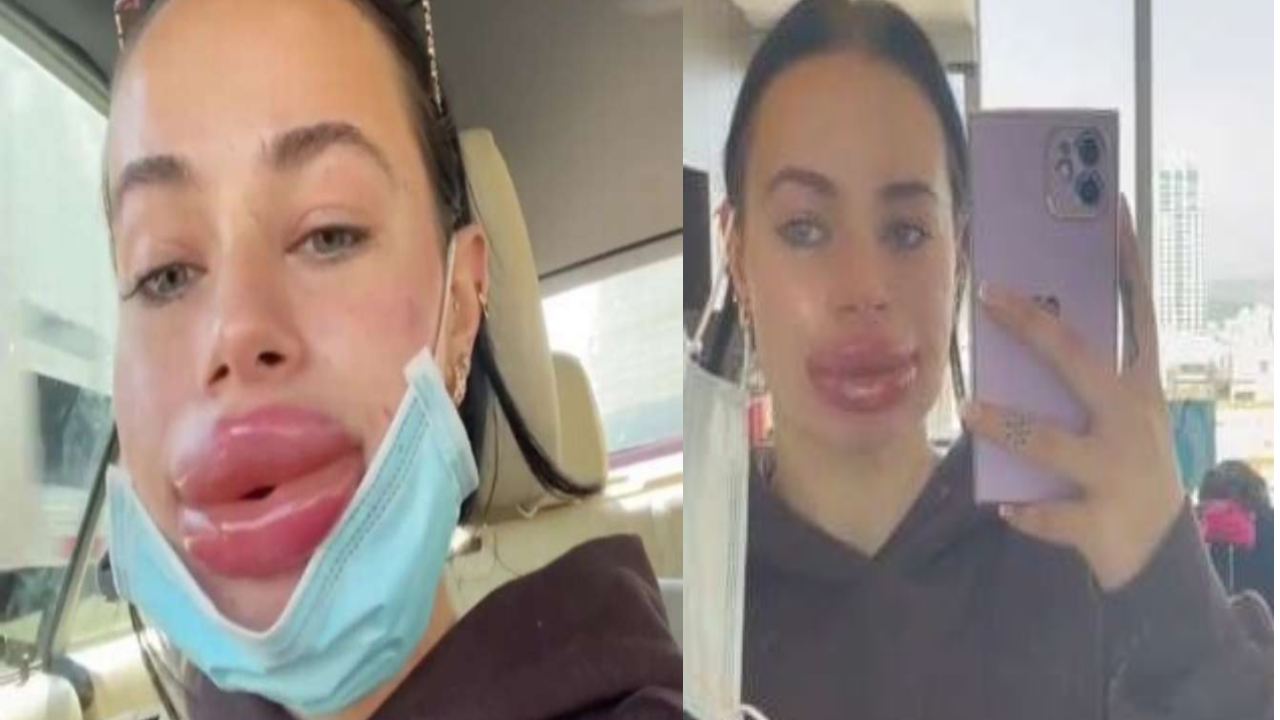 lip filler surgery : ఏదో కార్టూన్ పాత్ర అనుకునేరు.. లిప్ ఫిల్లింగ్ సర్జరీ ఫెయిలై ఇలా భయంకరంగా.. lip filler surgery : ఏదో కార్టూన్ పాత్ర అనుకునేరు.. లిప్ ఫిల్లింగ్ సర్జరీ ఫెయిలై ఇలా భయంకరంగా..