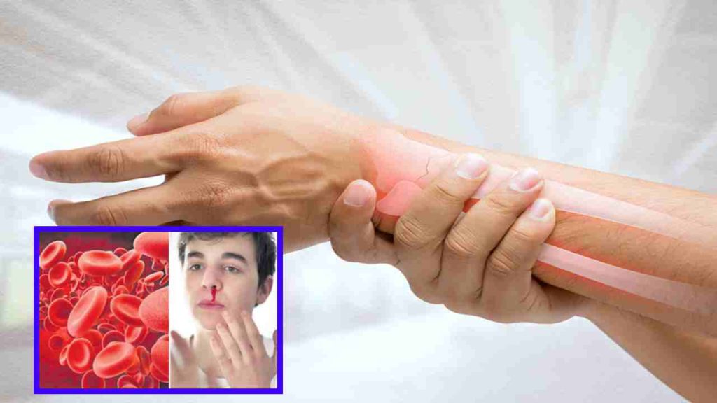 Hemophilia