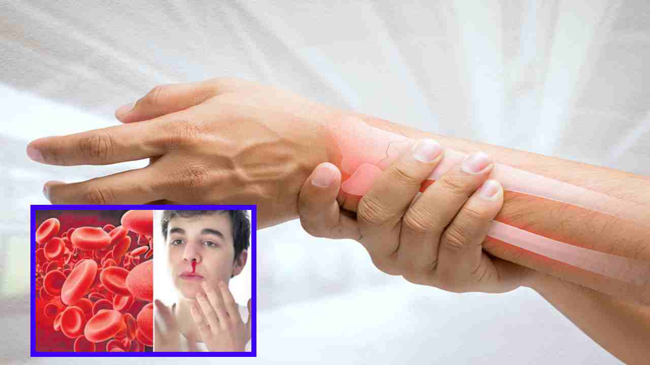 Hemophilia : హీమోఫిలియా ఎందుకొస్తుంది ? లక్షణాలు, సంకేతాలు ! Hemophilia : హీమోఫిలియా ఎందుకొస్తుంది ? లక్షణాలు, సంకేతాలు !