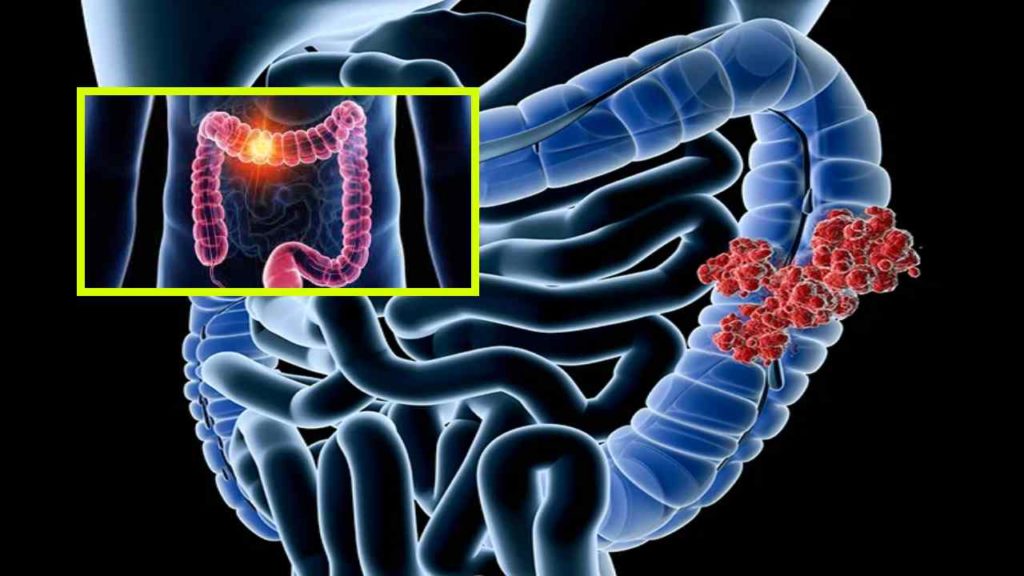 Colorectal Colon Cancer