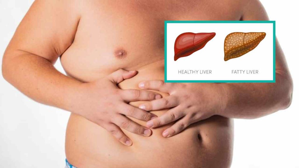 Fatty Liver Problem
