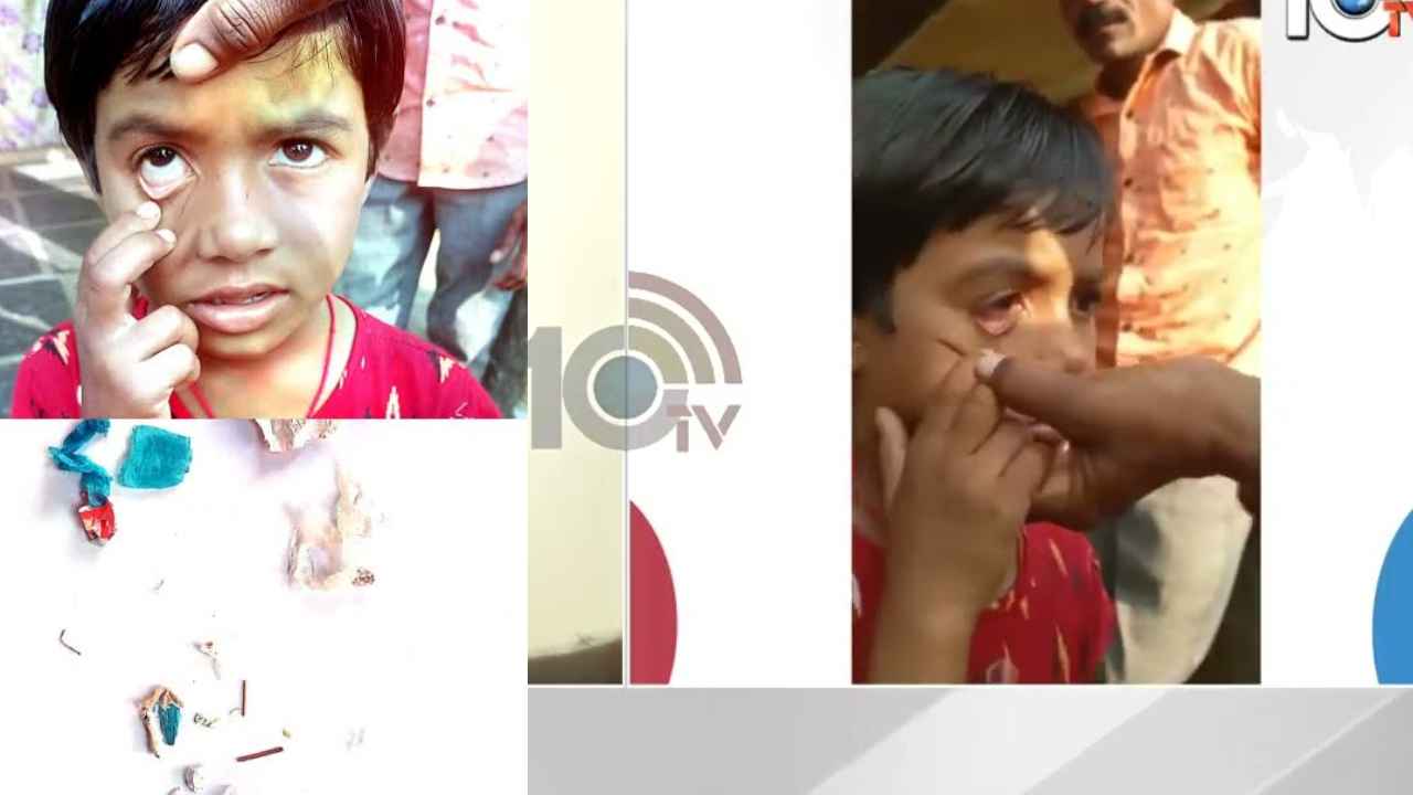 Girls Eye : షాకింగ్.. బాలిక కంట్లో నుంచి ప్లాస్టిక్, పేపర్, ఇనుప ముక్కలు.. ఎందుకిలా? Girls Eye : షాకింగ్.. బాలిక కంట్లో నుంచి ప్లాస్టిక్, పేపర్, ఇనుప ముక్కలు.. ఎందుకిలా?