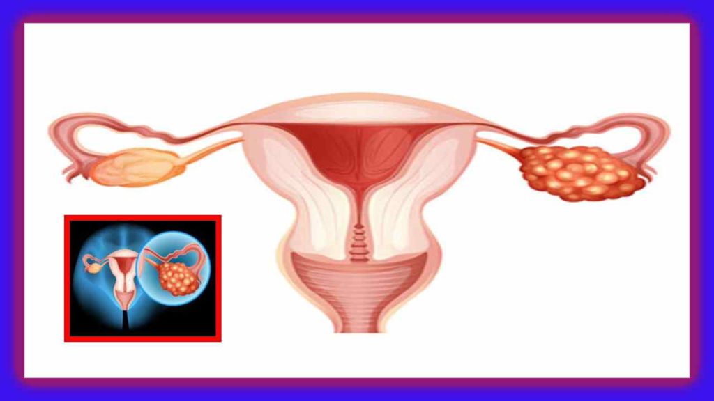 Ovarian Cancer