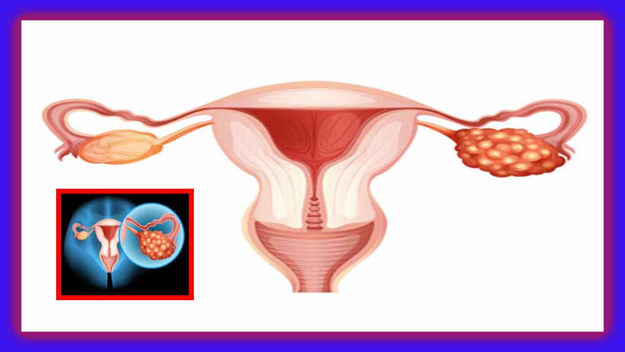 Ovarian Cancer : అండాశయ క్యాన్సర్ అసాధారణ లక్షణాలు.. ఈ సైలెంట్ కిల్లర్ని ఎలా గుర్తించాలి ? Ovarian Cancer : అండాశయ క్యాన్సర్ అసాధారణ లక్షణాలు.. ఈ సైలెంట్ కిల్లర్ని ఎలా గుర్తించాలి ?