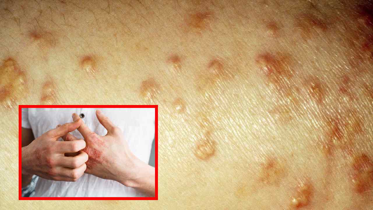 Diabetes Affects The Skin : మధుమేహం చర్మంపై ఎలాంటి ప్రభావం చూపుతుందో తెలుసా? ఈ లక్షణాల కనిపిస్తే జాగ్రత్త పడటం మంచిది.. Diabetes Affects The Skin : మధుమేహం చర్మంపై ఎలాంటి ప్రభావం చూపుతుందో తెలుసా? ఈ లక్షణాల కనిపిస్తే జాగ్రత్త పడటం మంచిది..