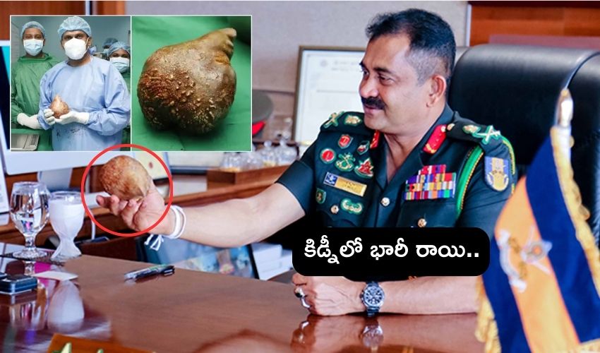 Sri Lanka : మాజీ సైనికుడి కిడ్నీలో 801 గ్రాముల రాయి .. ఇదో ప్రపంచ రికార్డు Sri Lanka : మాజీ సైనికుడి కిడ్నీలో 801 గ్రాముల రాయి .. ఇదో ప్రపంచ రికార్డు