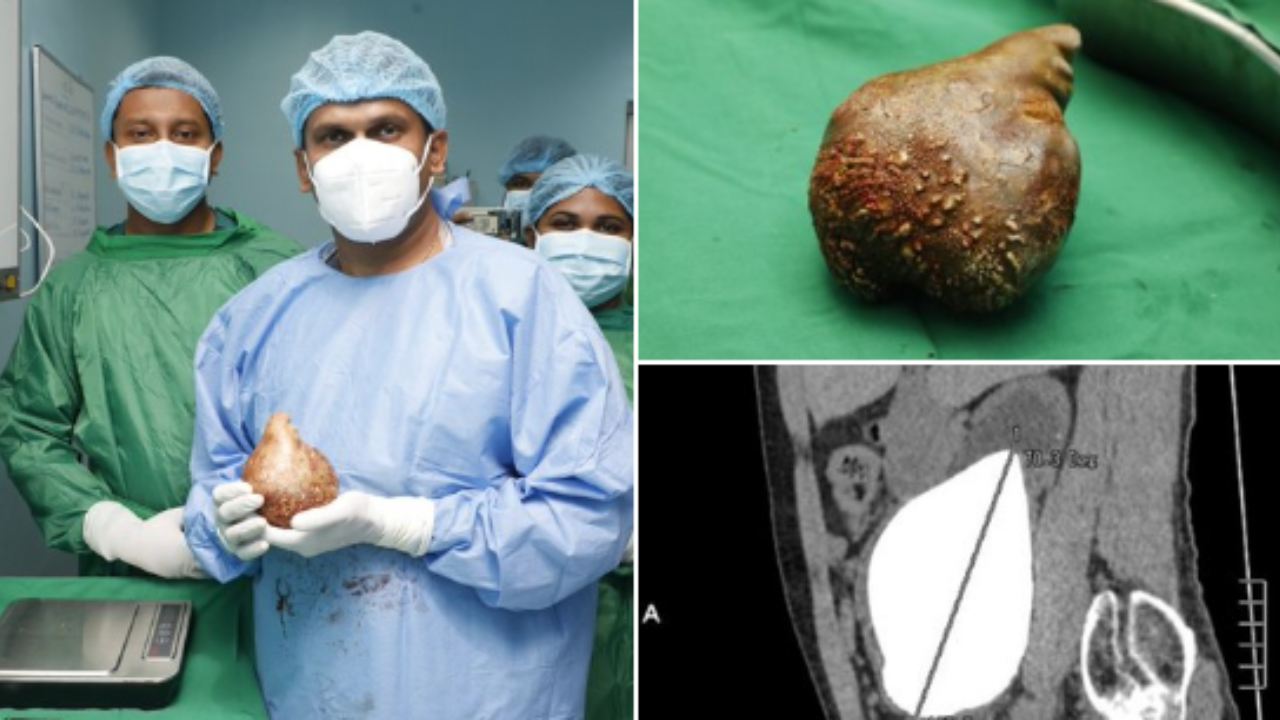 Heaviest kidney stone : 800 గ్రాముల కిడ్నీ స్టోన్ తొలగించిన శ్రీలంక వైద్యులు .. ప్రపంచ రికార్డులో నమోదైన కేసు Heaviest kidney stone : 800 గ్రాముల కిడ్నీ స్టోన్ తొలగించిన శ్రీలంక వైద్యులు .. ప్రపంచ రికార్డులో నమోదైన కేసు