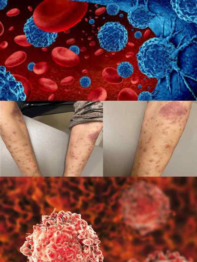 >లుకేమియా లక్షణాలు