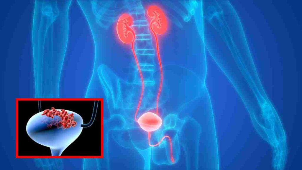 bladder cancer