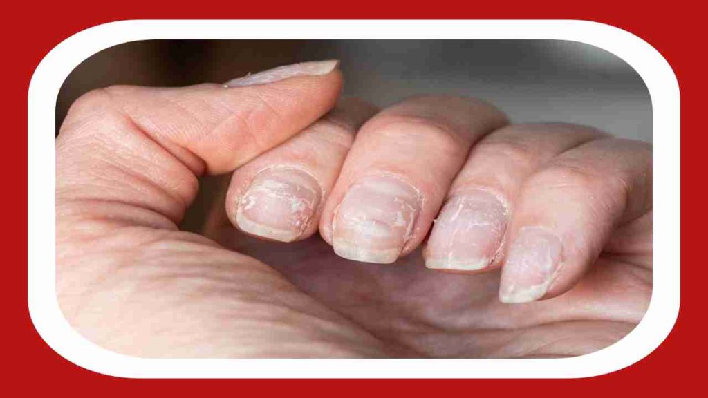 The Link Between Brittle Nails and Menopause - Elektra Health