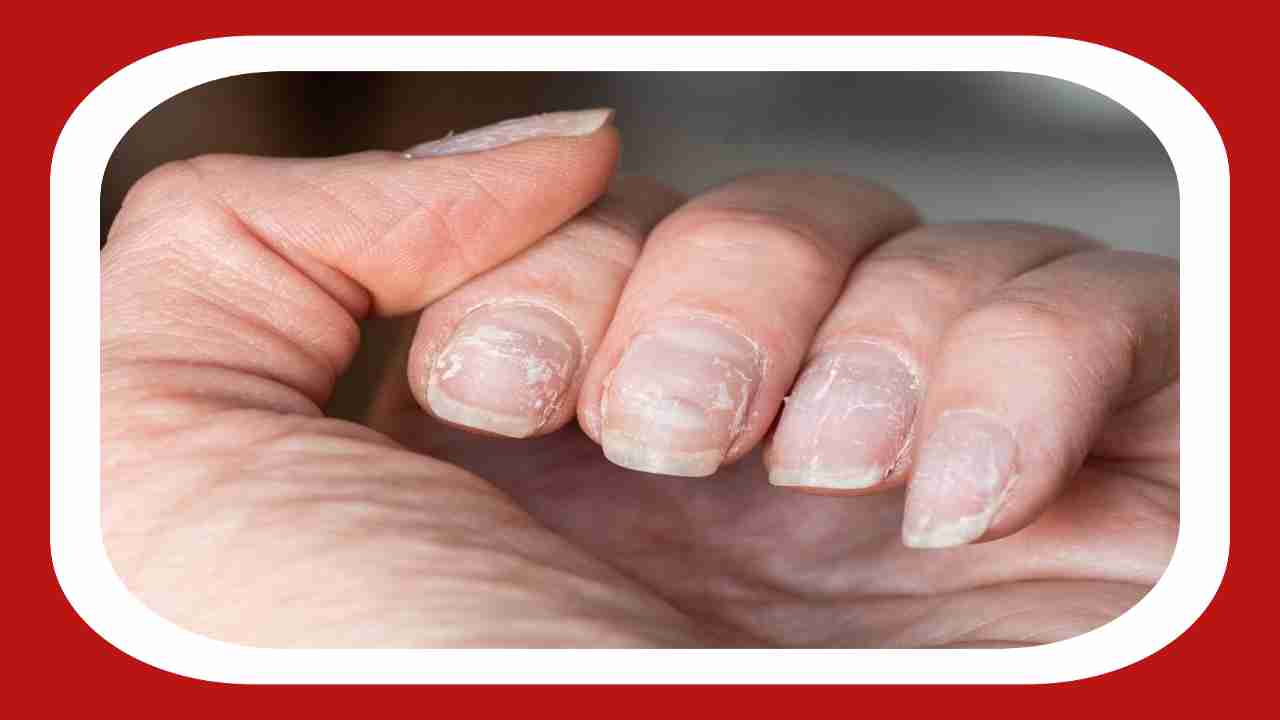 Spots on Nails : గోర్లపై తెల్లని మచ్చలు ఉన్నాయా.. ఇవే కారణాలు.. - what  causes white spots on nails - Samayam Telugu