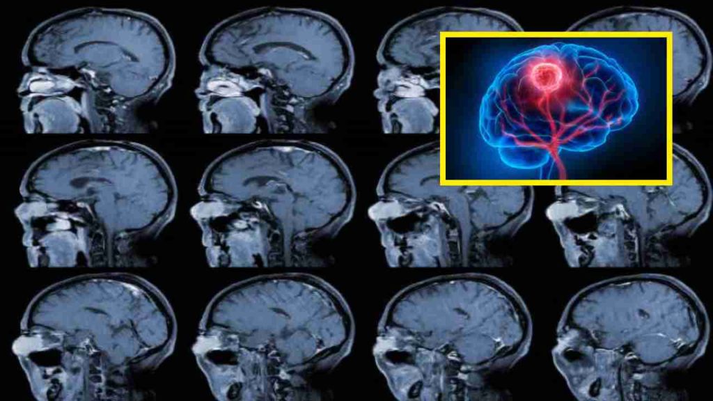 Brain Cancer