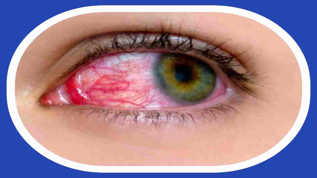 Conjunctivitis Scare : వేగంగా వ్యాప్తి చెందుతున్న కండ్లకలక.. ప్రయాణసమయాల్లో తీసుకోవాల్సిన జాగ్రత్తలు ! Conjunctivitis Scare : వేగంగా వ్యాప్తి చెందుతున్న కండ్లకలక.. ప్రయాణసమయాల్లో తీసుకోవాల్సిన జాగ్రత్తలు !