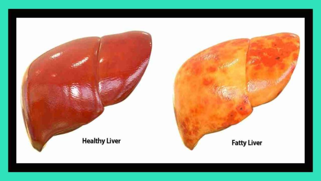 Fatty Liver Disease