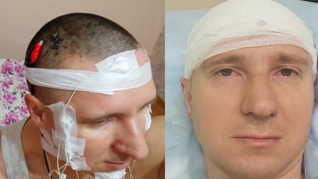 Man 'Dream Controlling' Chip In Brain