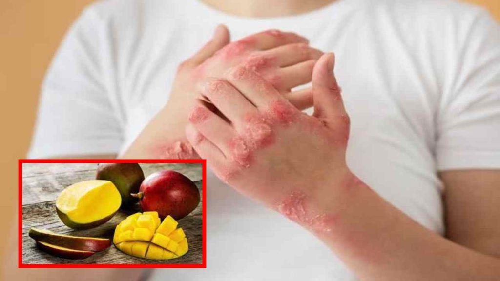 Mango allergy