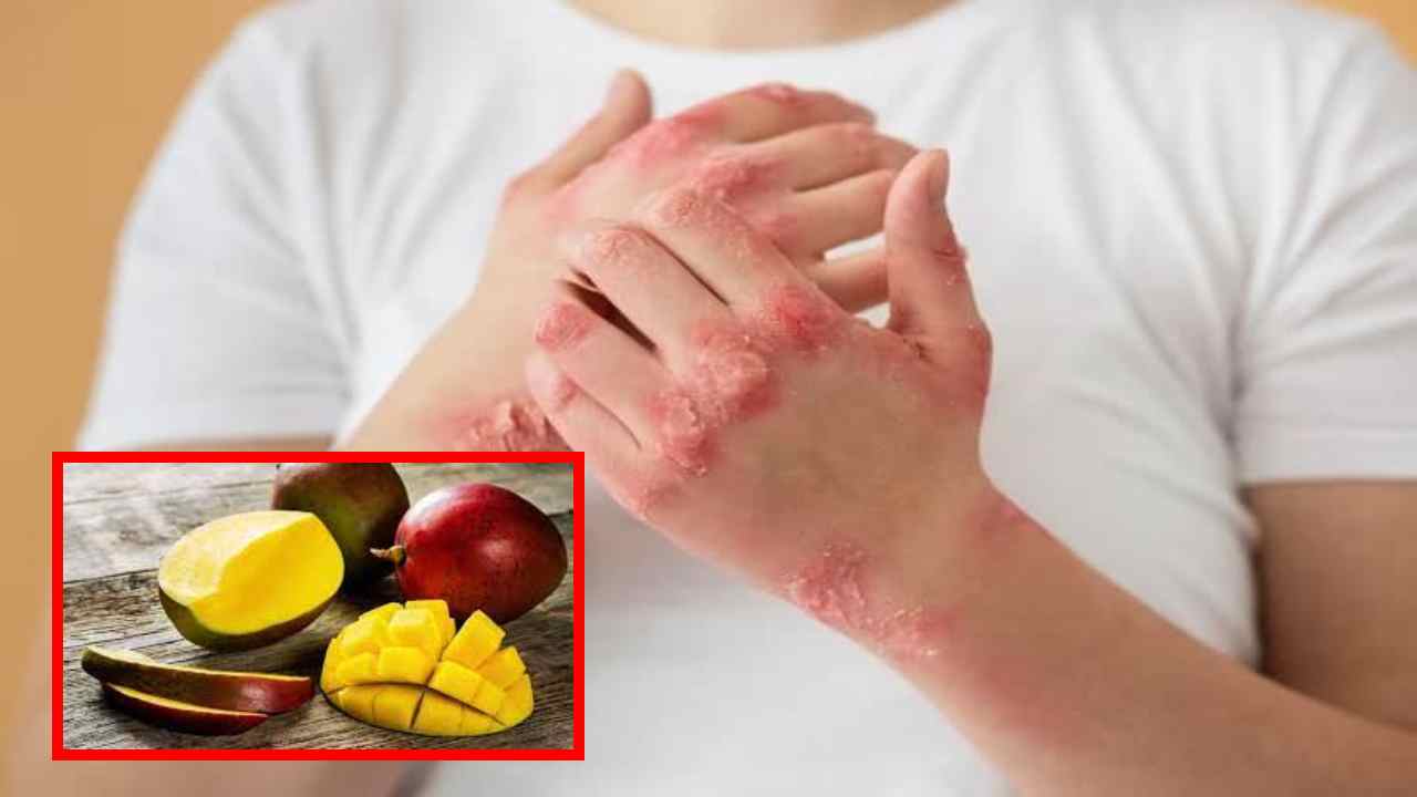 Skin Allergies : మామిడి పండు చర్మానికి అలెర్జీని కలిగిస్తుందా? Skin Allergies : మామిడి పండు చర్మానికి అలెర్జీని కలిగిస్తుందా?
