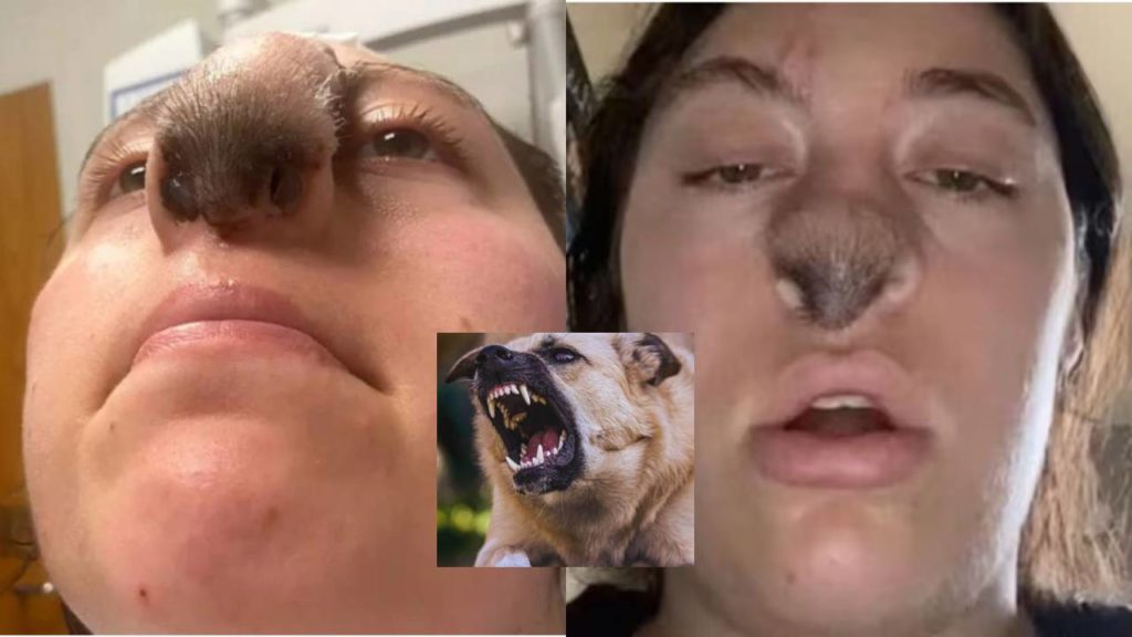 Pet Dog bite..Hair growing on woman nose