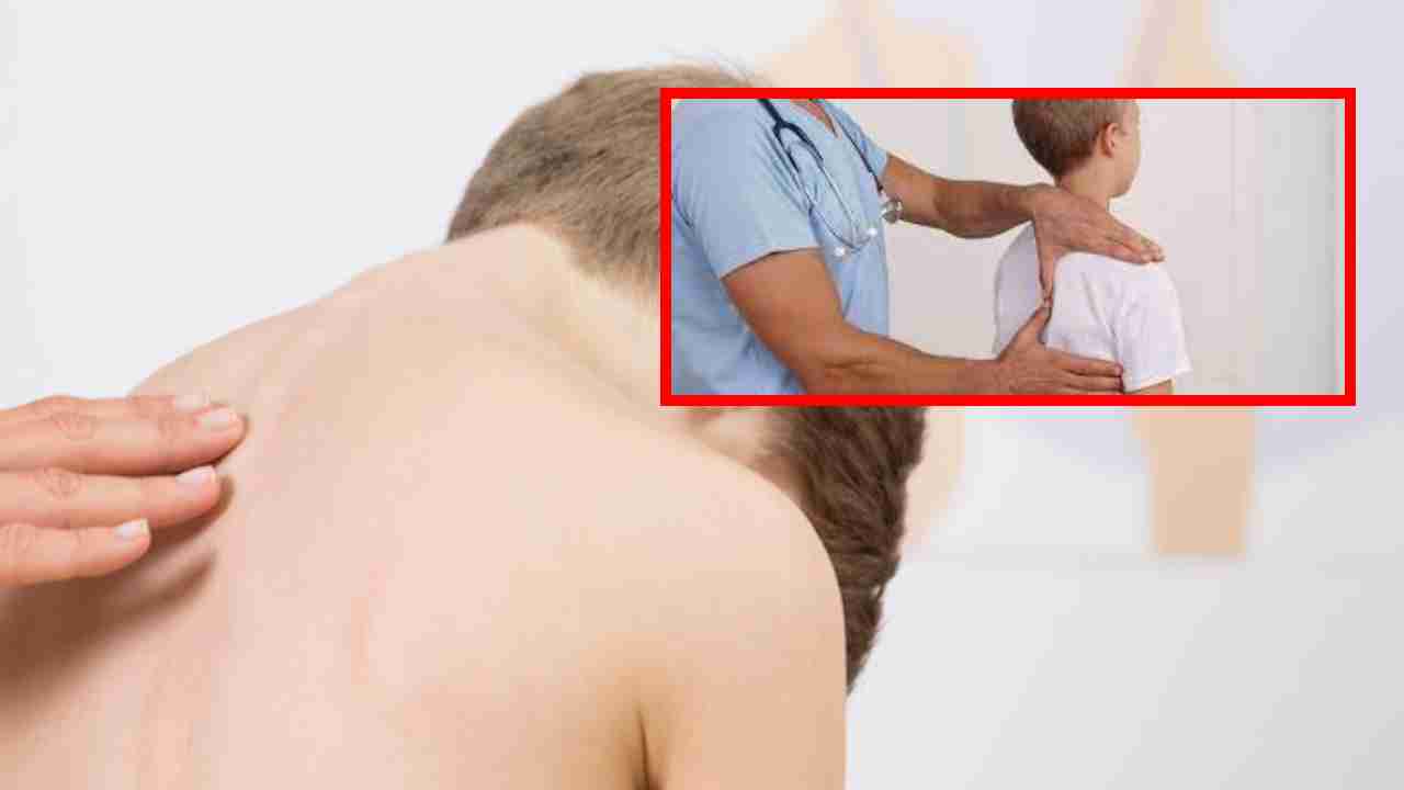 Sign of Scoliosis : మీ పిల్లలలో భుజాలు, తుంటి లో అసమానతలు ఉన్నాయా ? ఇది పార్శ్వగూని సంకేతమా? Sign of Scoliosis : మీ పిల్లలలో భుజాలు, తుంటి లో అసమానతలు ఉన్నాయా ? ఇది పార్శ్వగూని సంకేతమా?