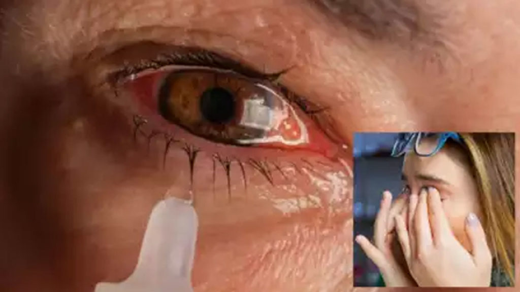 What are the symptoms of eye flu and Learn how to protect yourself