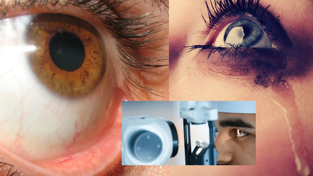 Watery Eyes Treatment