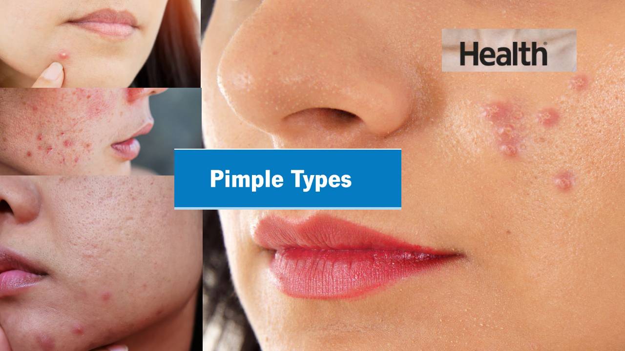 Pimples : మీ ముఖంపై మొటిమలే చెబుతాయి మీ ఆరోగ్యం గురించి.. Pimples : మీ ముఖంపై మొటిమలే చెబుతాయి మీ ఆరోగ్యం గురించి..