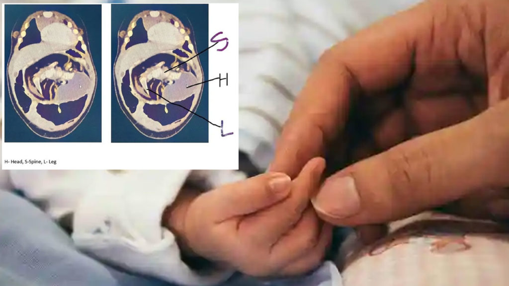 Months child develops fetus then leaves medical experts shocked