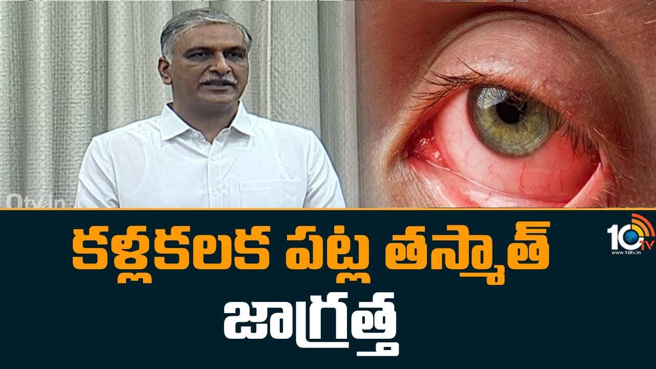 Harish Rao : కళ్లకలక పట్ల తస్మాత్ జాగ్రత్త