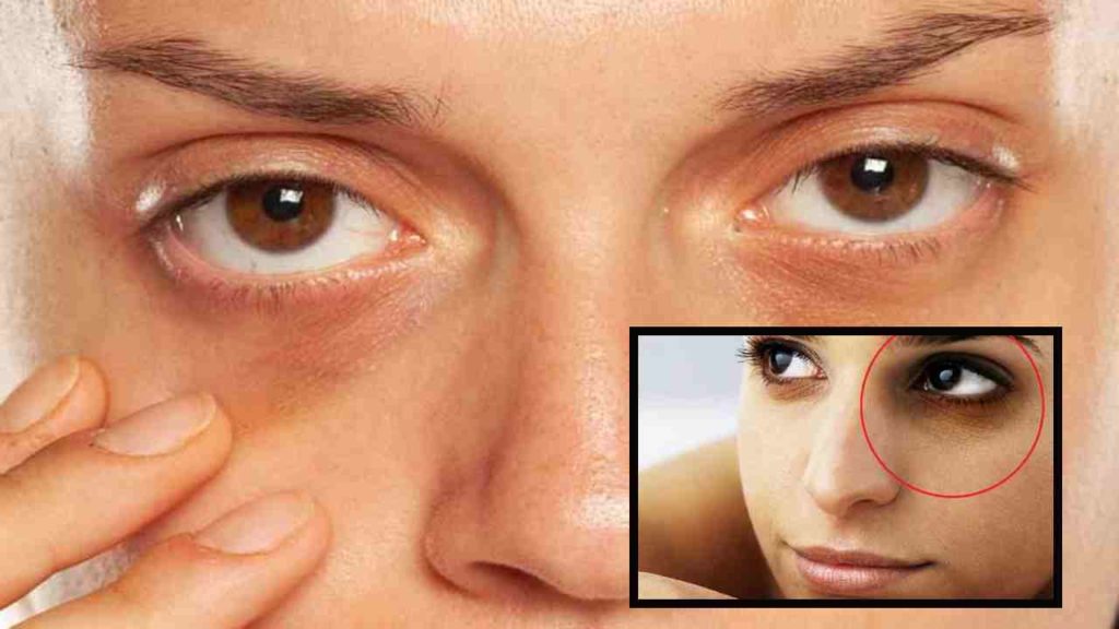 Dark Circles Under Eyes