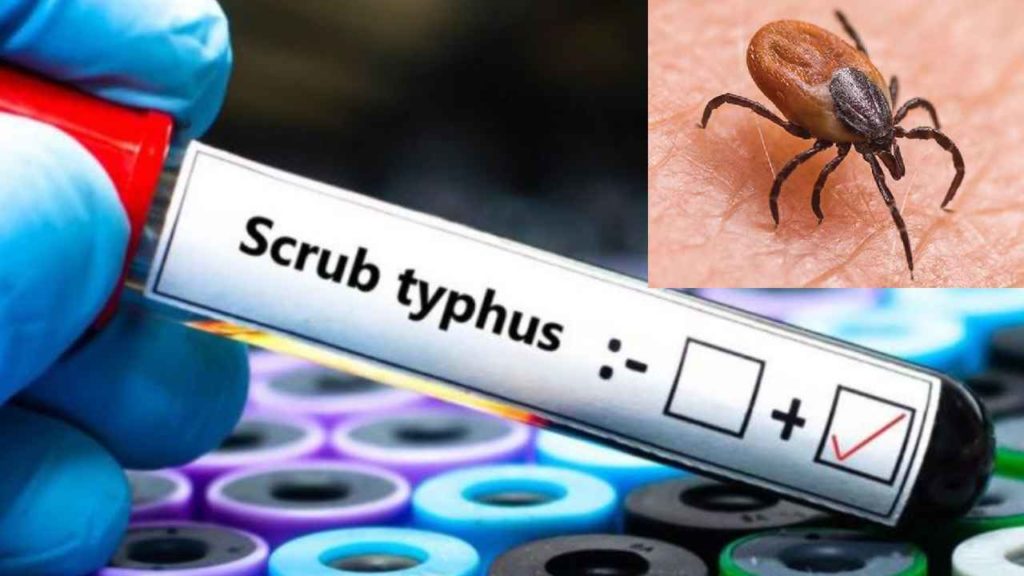 Scrub Typhus