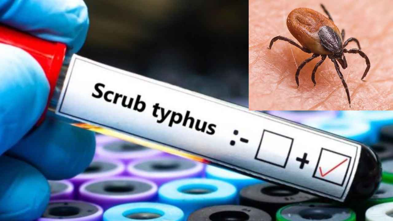 Scrub Typhus : బాబోయ్.. భయపెడుతున్న స్క్రబ్ టైఫస్, 180కి పెరిగిన కేసుల సంఖ్య, 5రోజుల పాటు జ్వరం ఉంటే డేంజరే Scrub Typhus : బాబోయ్.. భయపెడుతున్న స్క్రబ్ టైఫస్, 180కి పెరిగిన కేసుల సంఖ్య, 5రోజుల పాటు జ్వరం ఉంటే డేంజరే