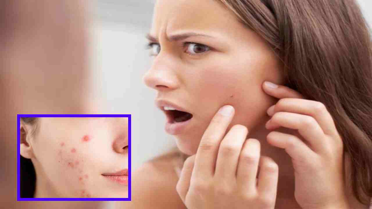 Acne Before Menstruation : రుతుక్రమానికి ముందు మొటిమల సమస్య బాధిస్తుంటే ! Acne Before Menstruation : రుతుక్రమానికి ముందు మొటిమల సమస్య బాధిస్తుంటే !