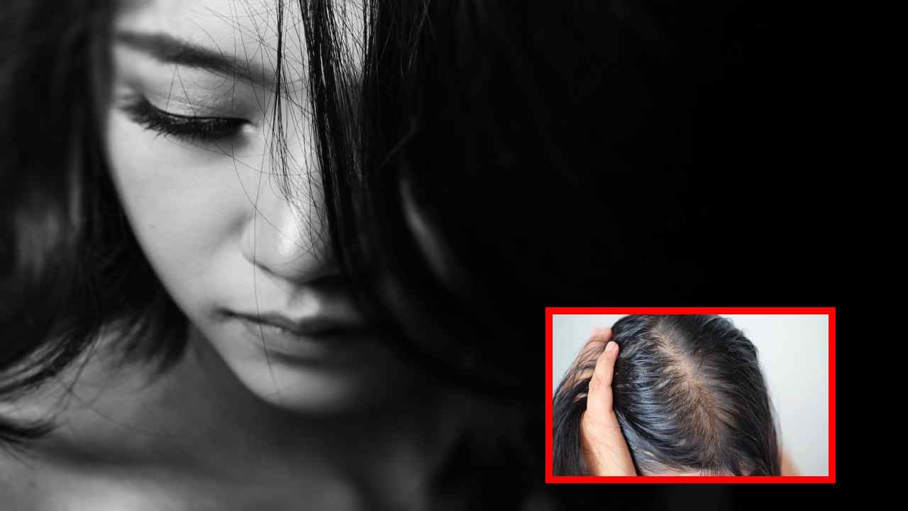Hair Regeneration : జుట్టు రీజనరేషన్ తో బట్టతలకు బైబై Hair Regeneration : జుట్టు రీజనరేషన్ తో బట్టతలకు బైబై