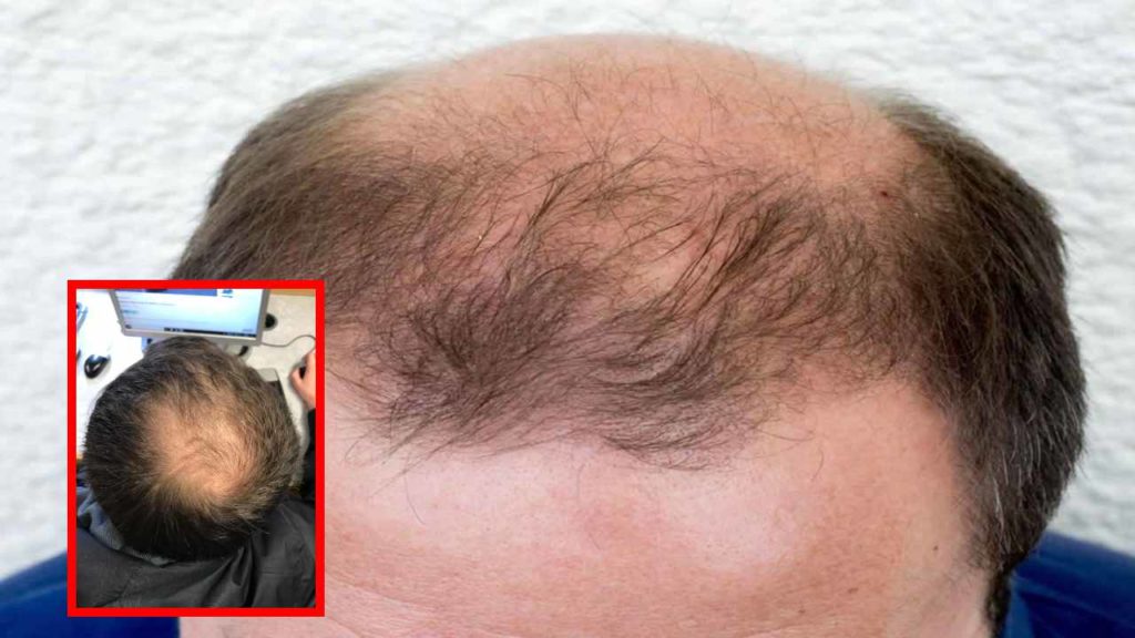 Early Balding