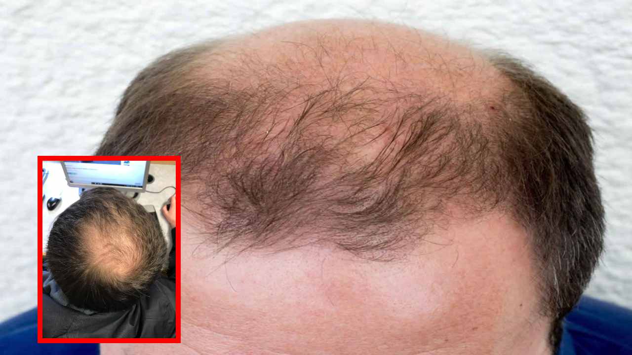 Male Baldness : పురుషుల్లో త్వరగా బట్టతల రావడం క్యాన్సర్కు సంకేతమా? Male Baldness : పురుషుల్లో త్వరగా బట్టతల రావడం క్యాన్సర్కు సంకేతమా?