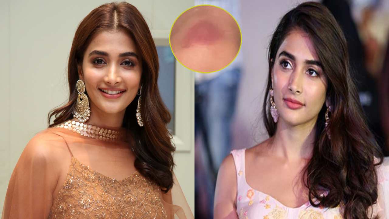 Pooja Hegde : పూజా హెగ్డే కాలికి గాయం..! ఆస్పత్రికి వెళ్లకుండా ఇన్స్టాగ్రామ్లో పోస్ట్..! Pooja Hegde : పూజా హెగ్డే కాలికి గాయం..! ఆస్పత్రికి వెళ్లకుండా ఇన్స్టాగ్రామ్లో పోస్ట్..!