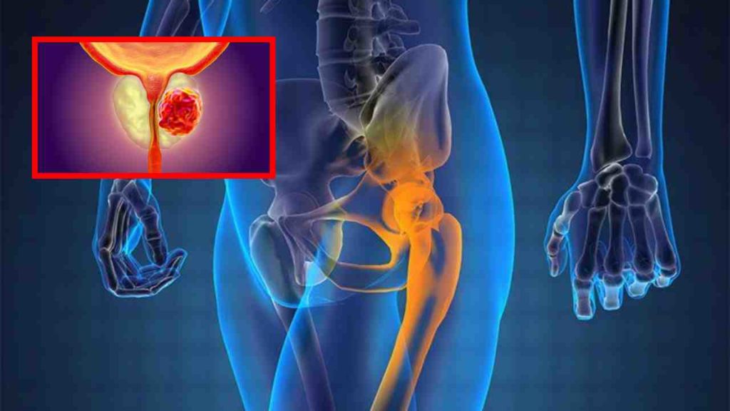 Prostate Cancer