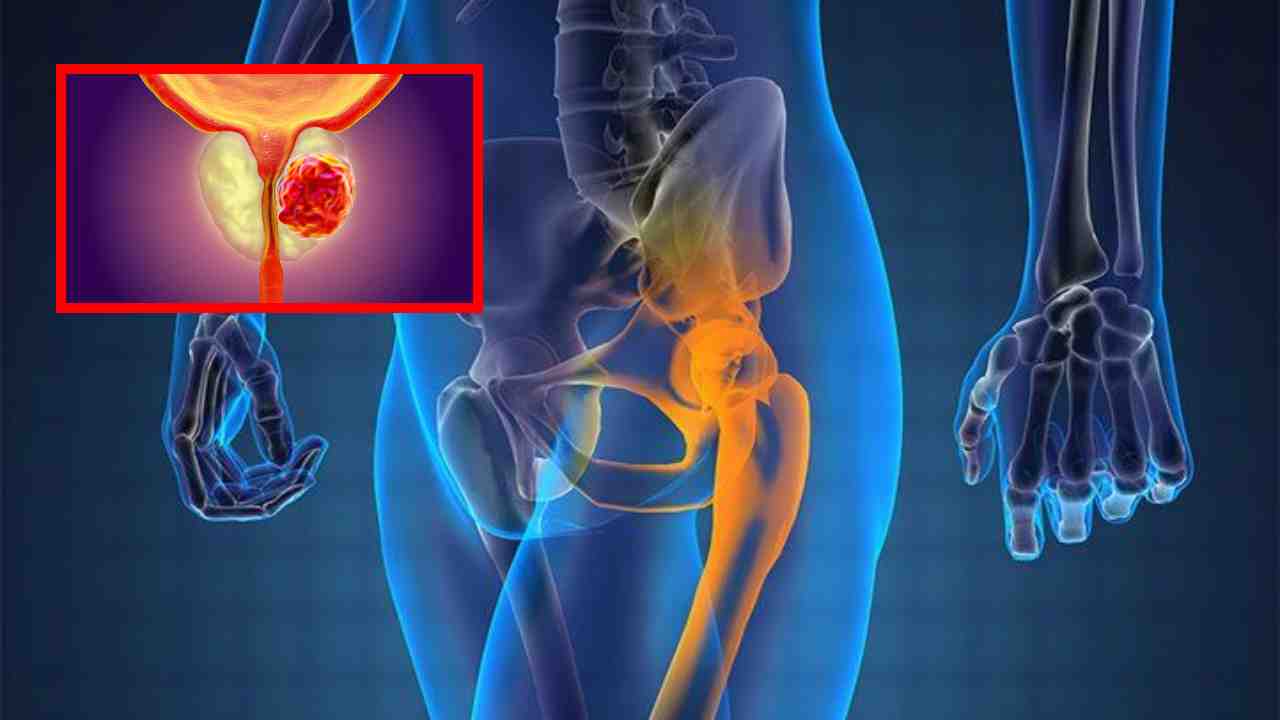 Prostate Cancer : ప్రోస్టేట్ క్యాన్సర్ గురించి మగవారు తెలుసుకోవలసిన విషయాలు ! Prostate Cancer : ప్రోస్టేట్ క్యాన్సర్ గురించి మగవారు తెలుసుకోవలసిన విషయాలు !