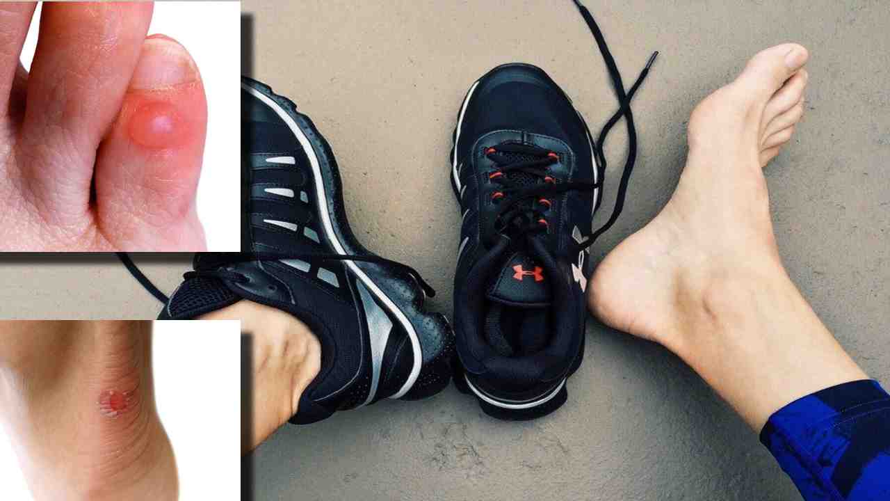 Shoe Bites : షూ కాటును నివారించాలంటే ఈ చిట్కాలను ప్రయత్నించి చూడండి ! Shoe Bites : షూ కాటును నివారించాలంటే ఈ చిట్కాలను ప్రయత్నించి చూడండి !