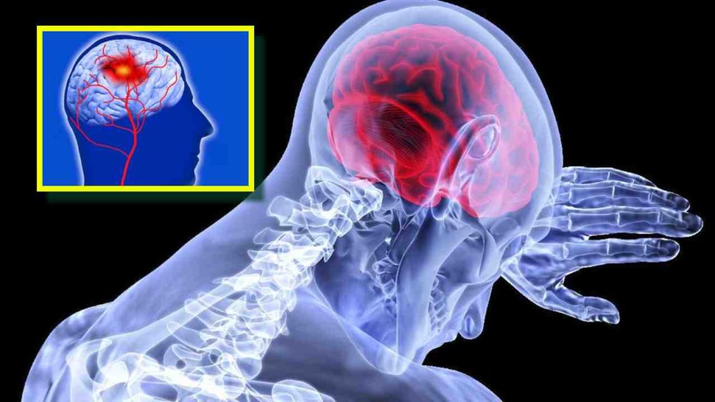 brain stroke