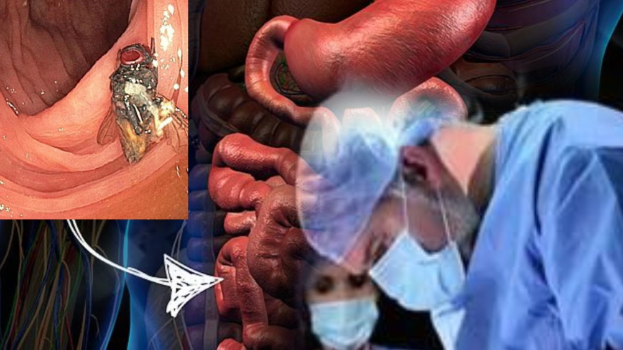 Fly in Man Intestines : 63 ఏళ్ల వ్యక్తి పేగులో ఈగ .. షాక్ అయిన డాక్టర్లు Fly in Man Intestines : 63 ఏళ్ల వ్యక్తి పేగులో ఈగ .. షాక్ అయిన డాక్టర్లు