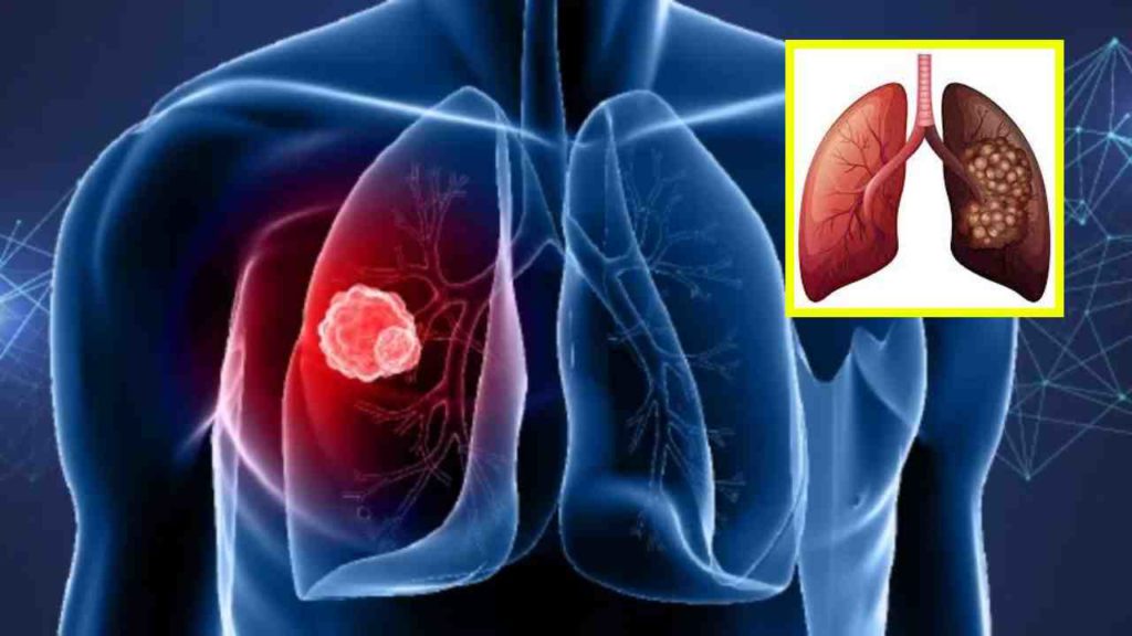 Lung Cancer