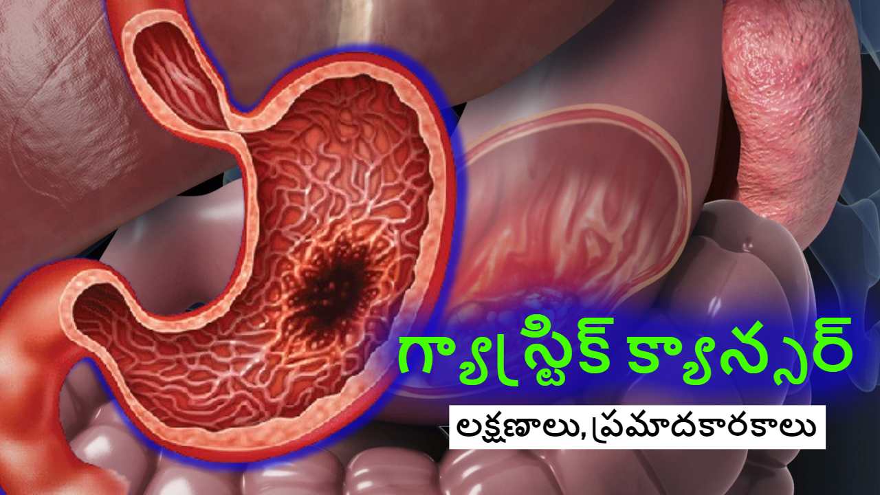 Gastric Cancer : కడుపులో ఇన్ఫెక్షన్ సమస్యలు గ్యాస్ట్రిక్ క్యాన్సర్ కు దారితీస్తాయా ? Gastric Cancer : కడుపులో ఇన్ఫెక్షన్ సమస్యలు గ్యాస్ట్రిక్ క్యాన్సర్ కు దారితీస్తాయా ?