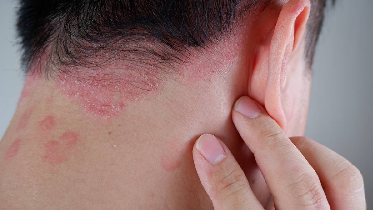 Psoriasis : ఒత్తిడి వల్ల సోరియాసిస్ వస్తుందట.. హెచ్చరిస్తున్న నిపుణులు Psoriasis : ఒత్తిడి వల్ల సోరియాసిస్ వస్తుందట.. హెచ్చరిస్తున్న నిపుణులు