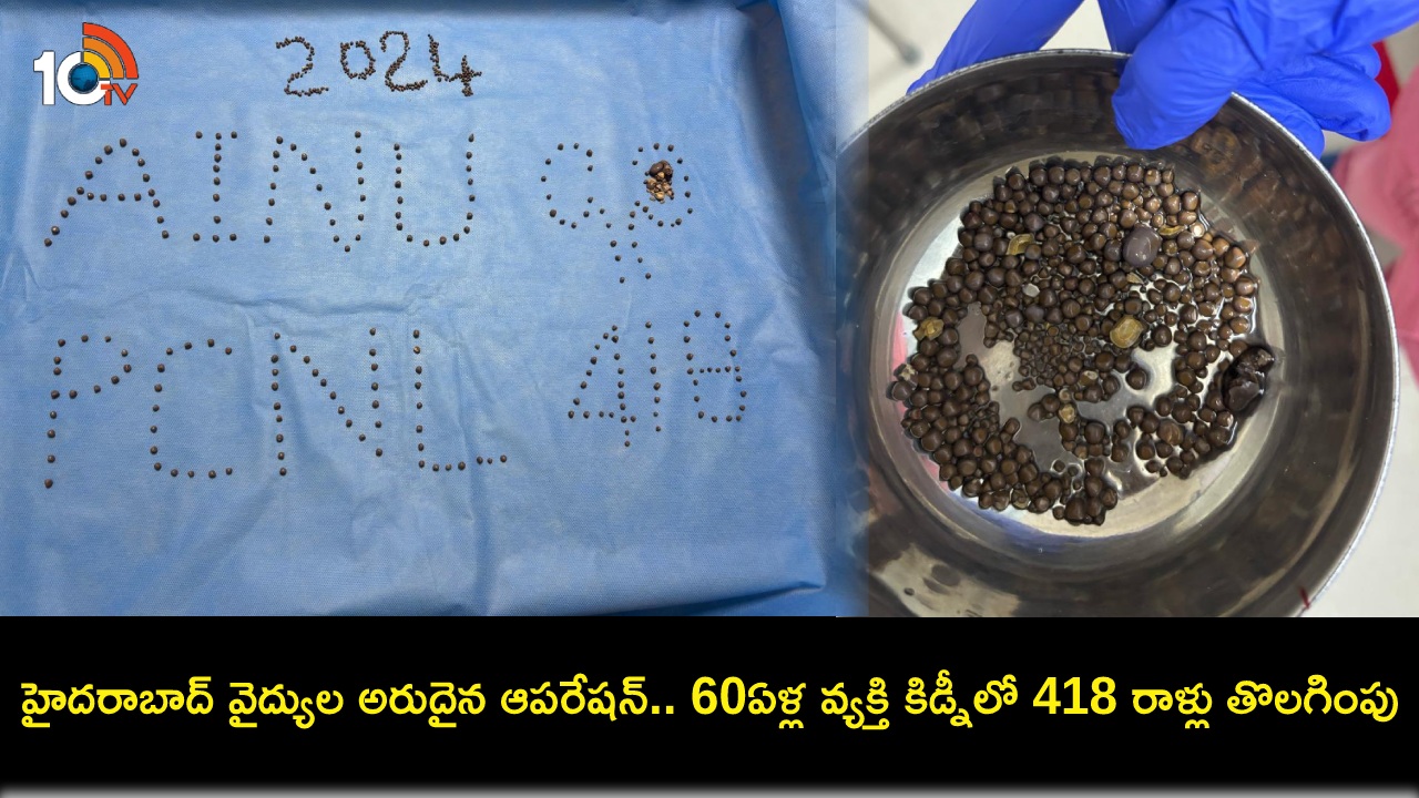 Hyderabad Hospital : హైదరాబాద్ వైద్యుల అరుదైన ఘనత.. 60ఏళ్ల వ్యక్తి కిడ్నీలో 418 రాళ్లను తొలగించారు..! Hyderabad Hospital : హైదరాబాద్ వైద్యుల అరుదైన ఘనత.. 60ఏళ్ల వ్యక్తి కిడ్నీలో 418 రాళ్లను తొలగించారు..!