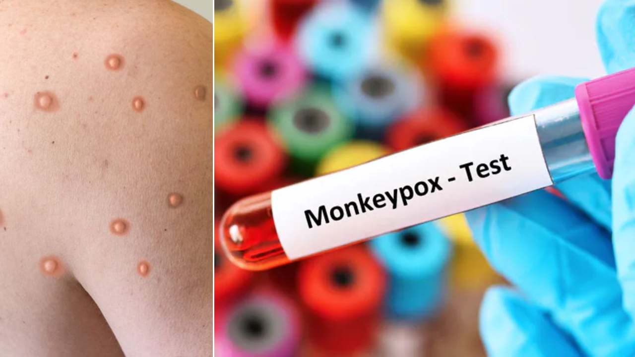 Monkeypox : మంకీపాక్స్ వైరస్ వచ్చేస్తుంది జాగ్రత్త.. రాష్ట్రాలకు కేంద్రం కీలక సూచనలు.. దేశంలో తొలికేసు నమోదు Monkeypox : మంకీపాక్స్ వైరస్ వచ్చేస్తుంది జాగ్రత్త.. రాష్ట్రాలకు కేంద్రం కీలక సూచనలు.. దేశంలో తొలికేసు నమోదు
