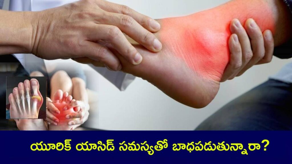 High Uric Acid