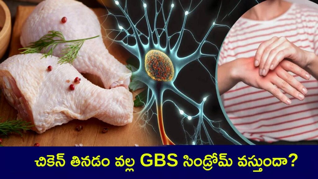 Eating Chicken Can be Cause GBS Syndrome