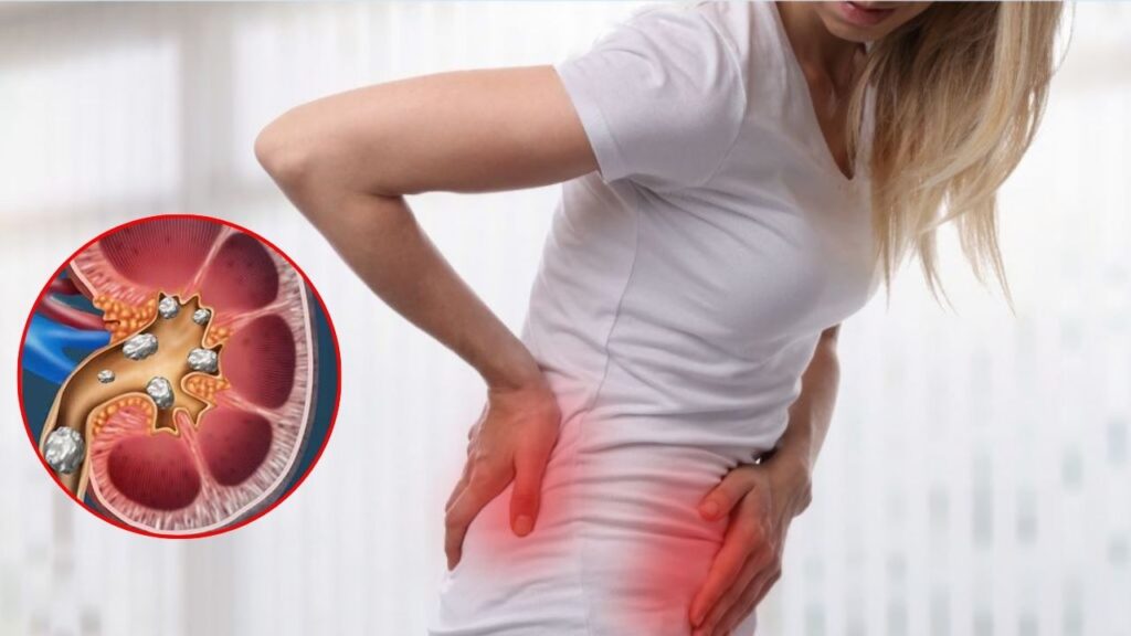 Kidney Stones Symptoms