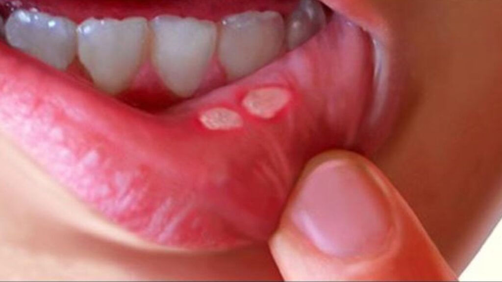 Mouth Ulcers Causes